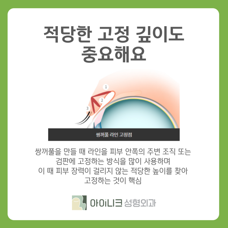 쌍꺼풀흉터 재수술 추천 원인과 해결방법 관련 이미지 8