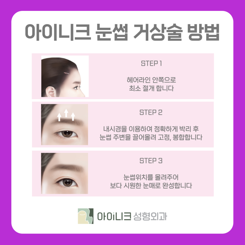 What Is Brow Lift Surgery in Apgujeong? image 5