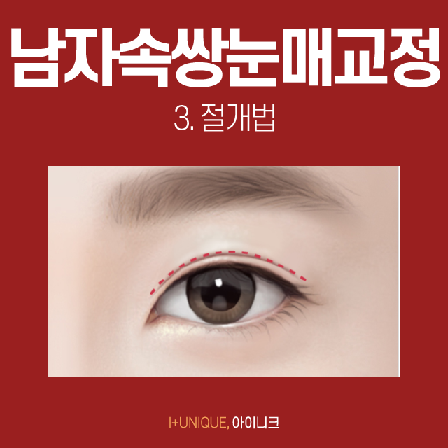 If You Want Natural, Clear Double Eyelids? Male Double-Eyelid Eye Correction Is the Answer! image 4
