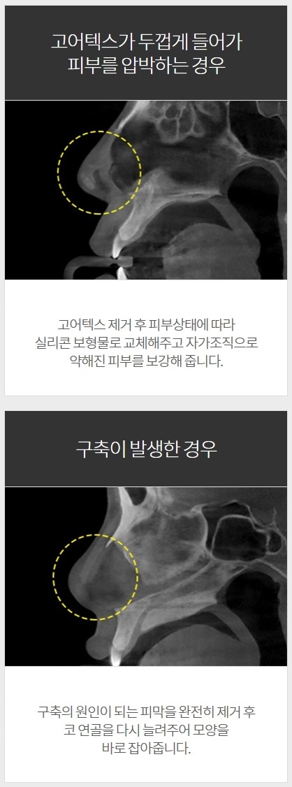 코구형구축 아이니크만의 솔루션이 정답! 관련 이미지 3