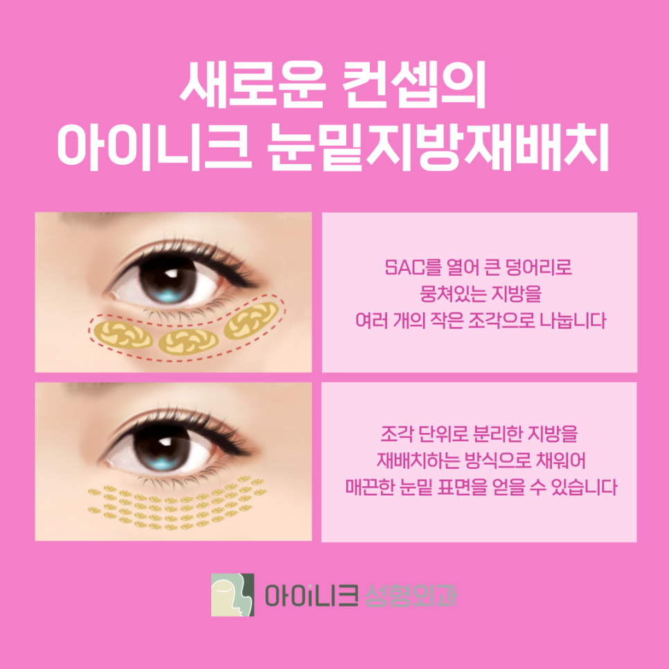 In What Cases Is Lower Eyelid Fat Repositioning in Yeoksam-dong Necessary? image 4