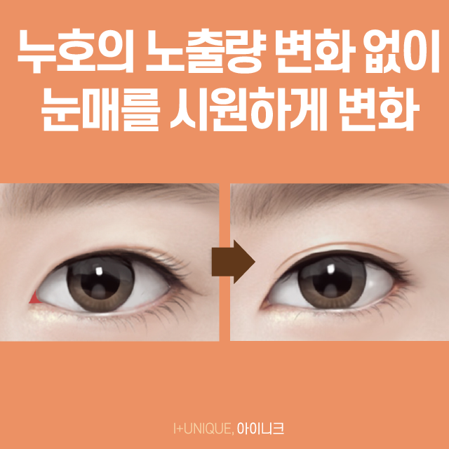 과교정으로 고생하고 있다면 아이니크의 앞트임재건수술로 해결! 관련 이미지 5