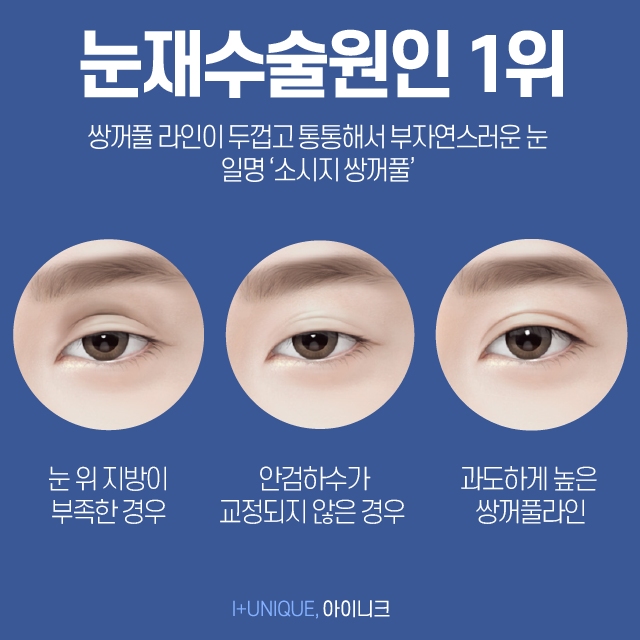 통통해서 부담스러운 내 눈, 쌍꺼풀라인낮추기로 처음부터 내 눈이였던 것처럼 관련 이미지 2