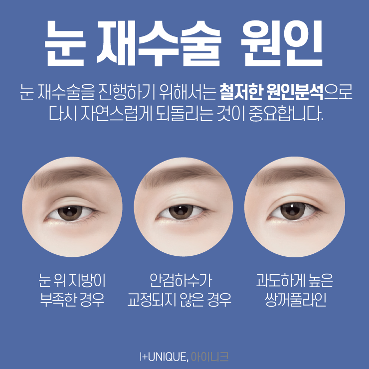 압구정성형외과 이제는 제대로보고 아이니크로 결정할 때 관련 이미지 4