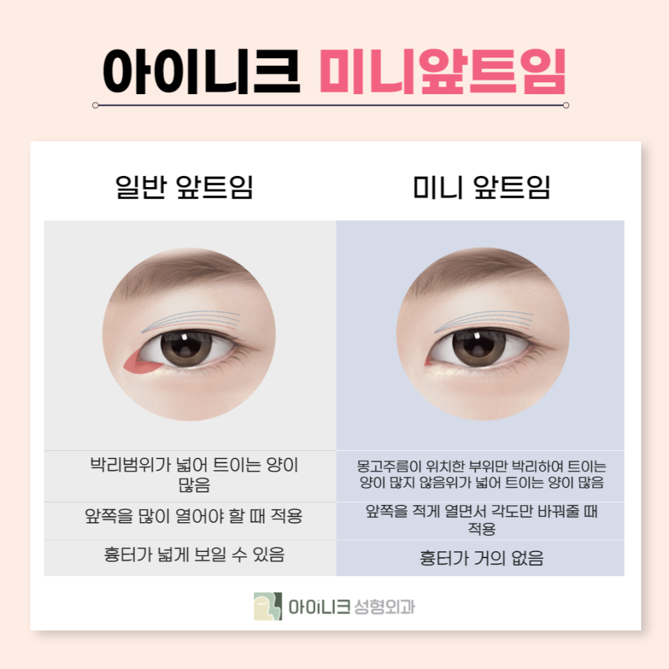 눈꼬리수술로 강아지상 만든 후기 관련 이미지 4