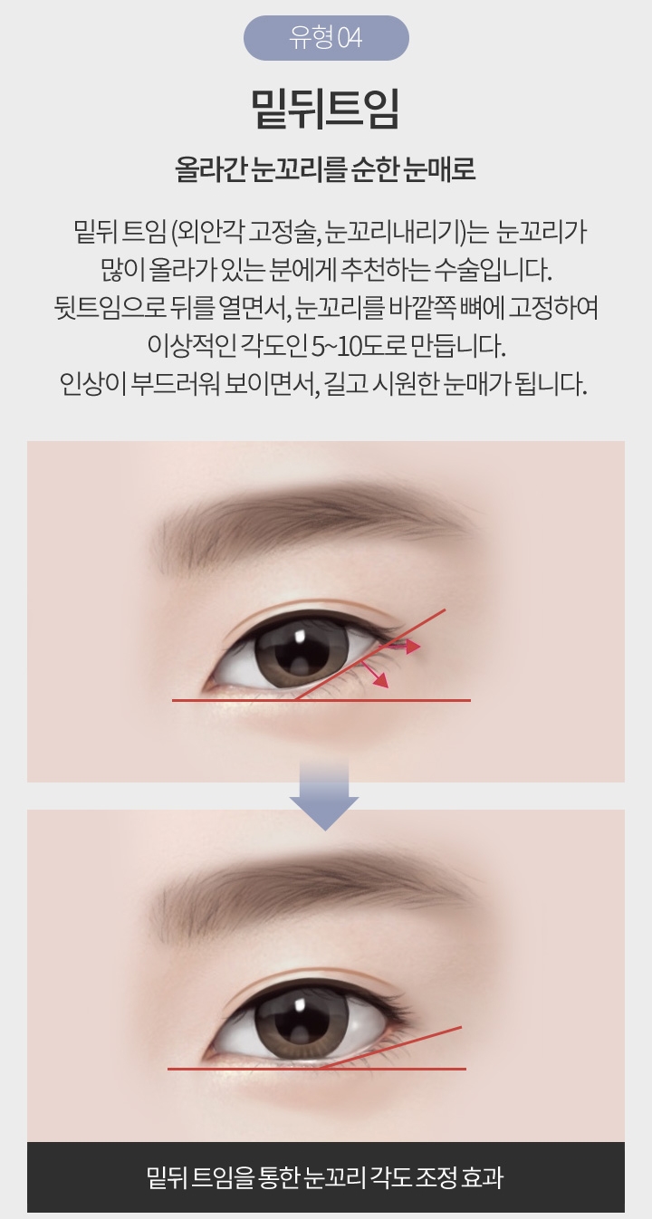 눈앞뒤트임 또렷한 눈매로 변신! 관련 이미지 7
