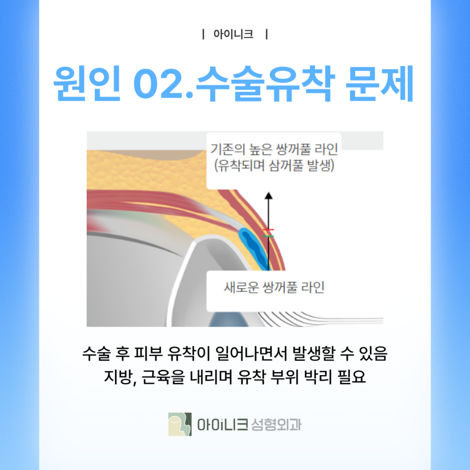 쌍꺼풀재수술병원 겹주름이 되어버렸다면? 관련 이미지 6