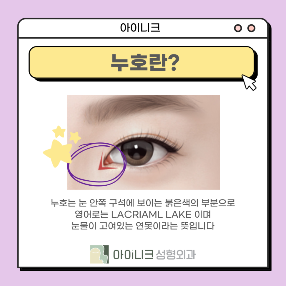 눈재수술성형외과 실패한 앞트임 재건 관련 이미지 10