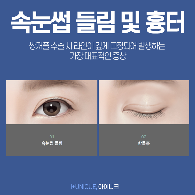 눈재수술성형외과 고를 때 이것만 알아주세요! 관련 이미지 4