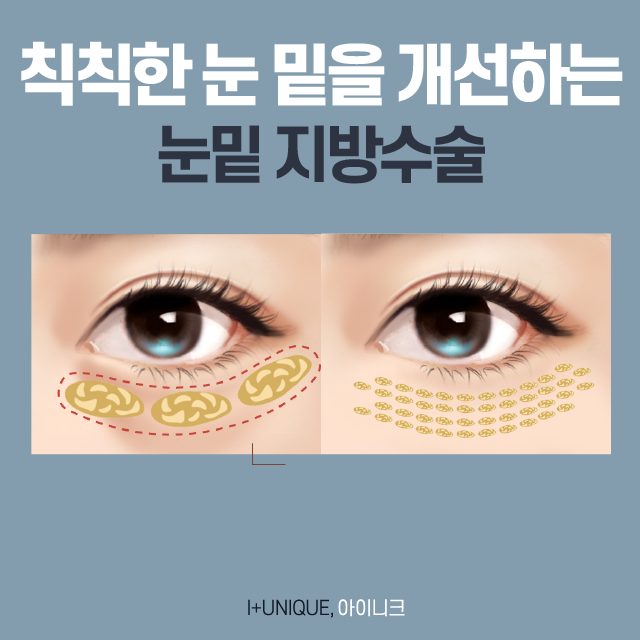 If You're Considering a New Year’s Gift of Filial Piety, Check Out the Types of Eye Surgery for People in Their 40s image 4