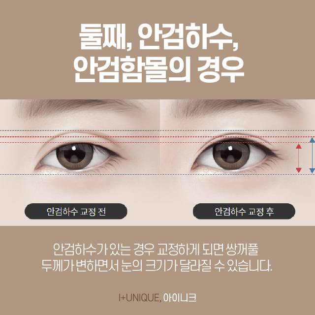 How Can Double Eyelid Line Reduction Be Done? image 5