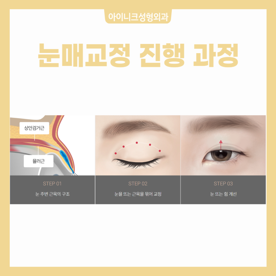 Making Sleepy-Looking Eyes Clear with Ptosis Correction image 4