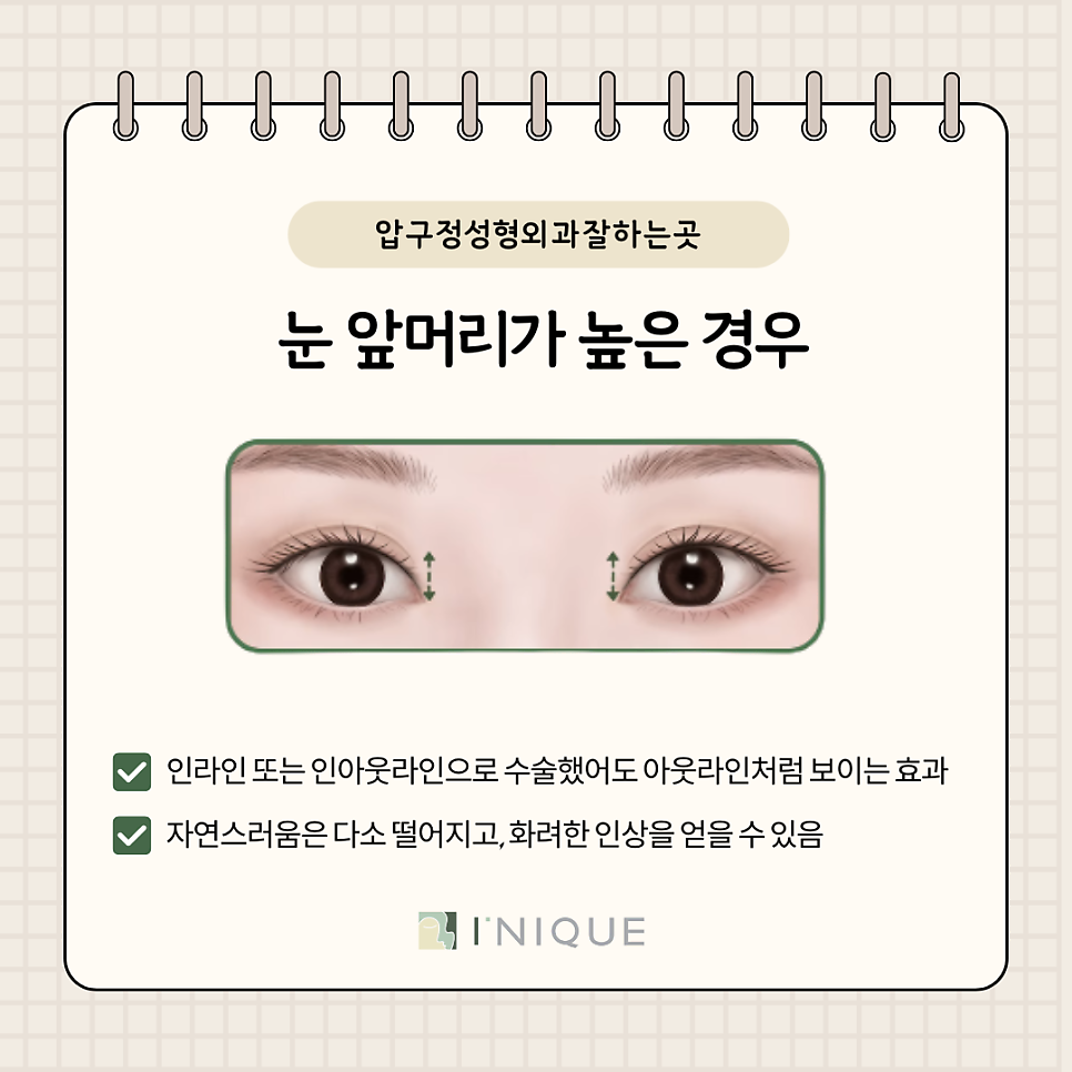 The Secret of Double Eyelid Height Revealed by a Best-Rated Apgujeong Plastic Surgery Clinic image 6