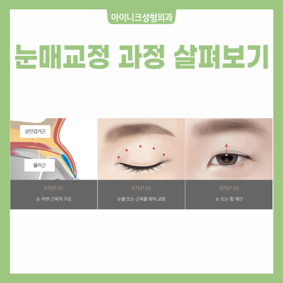 졸린눈수술로 또렷한 눈매를 만들자! 관련 이미지 5