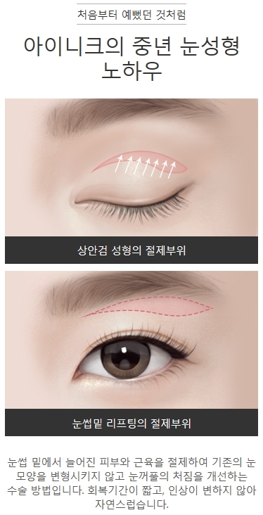중년쌍꺼풀수술 눈썹밑 리프팅으로 깨끗하게 관련 이미지 2