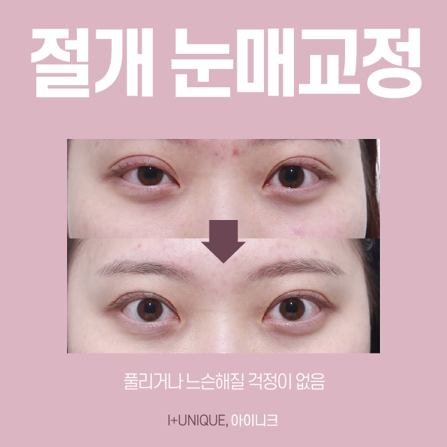 Learn About Incision and Non-Incision Ptosis Correction Without Side Effects image 5