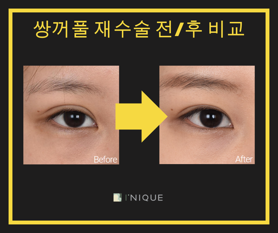 Revisional Eye Surgery: You Need to Know ‘This’ to Succeed! image 6
