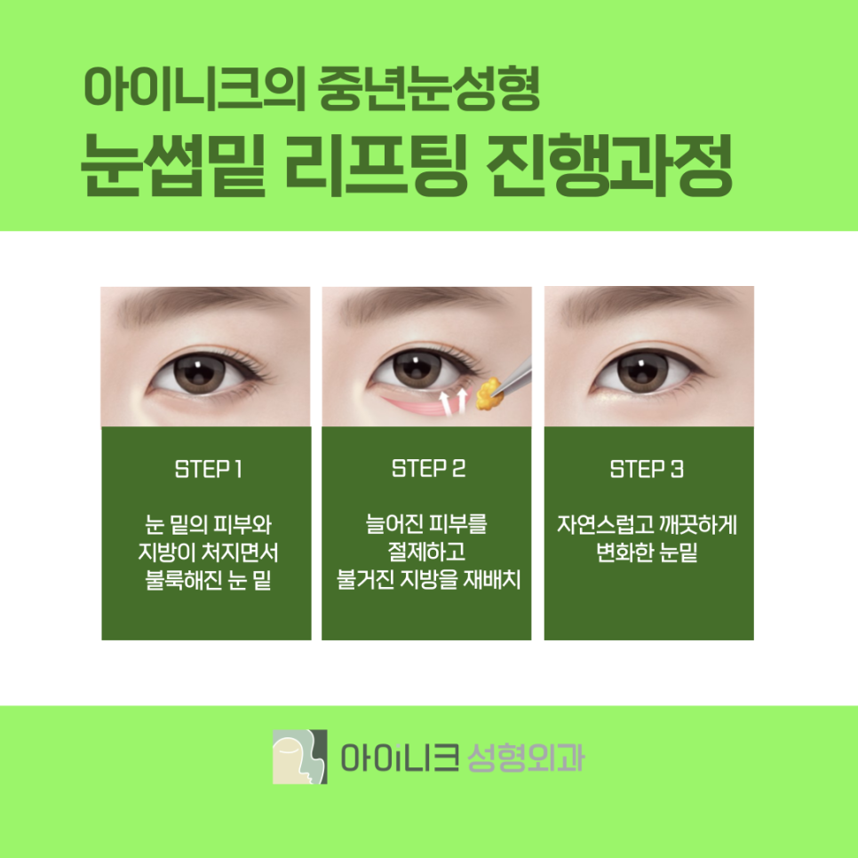 쌍수병원 잘하는곳에서 20대의 눈매로 돌아가기 관련 이미지 11