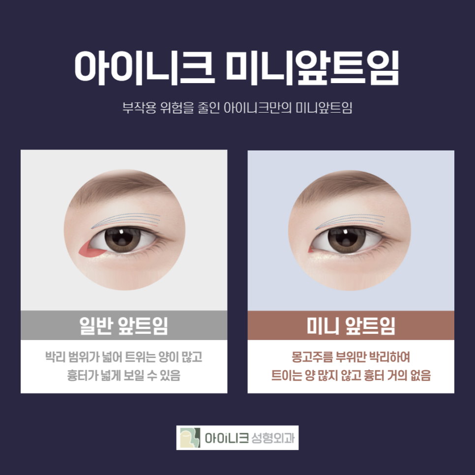 Recommended Eye Surgery! Two Procedures with Less Scarring and Faster Recovery image 5