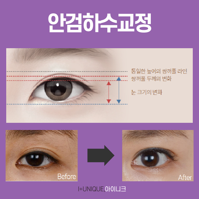 눈재수술유명한곳 제대로 찾는다면? 관련 이미지 4