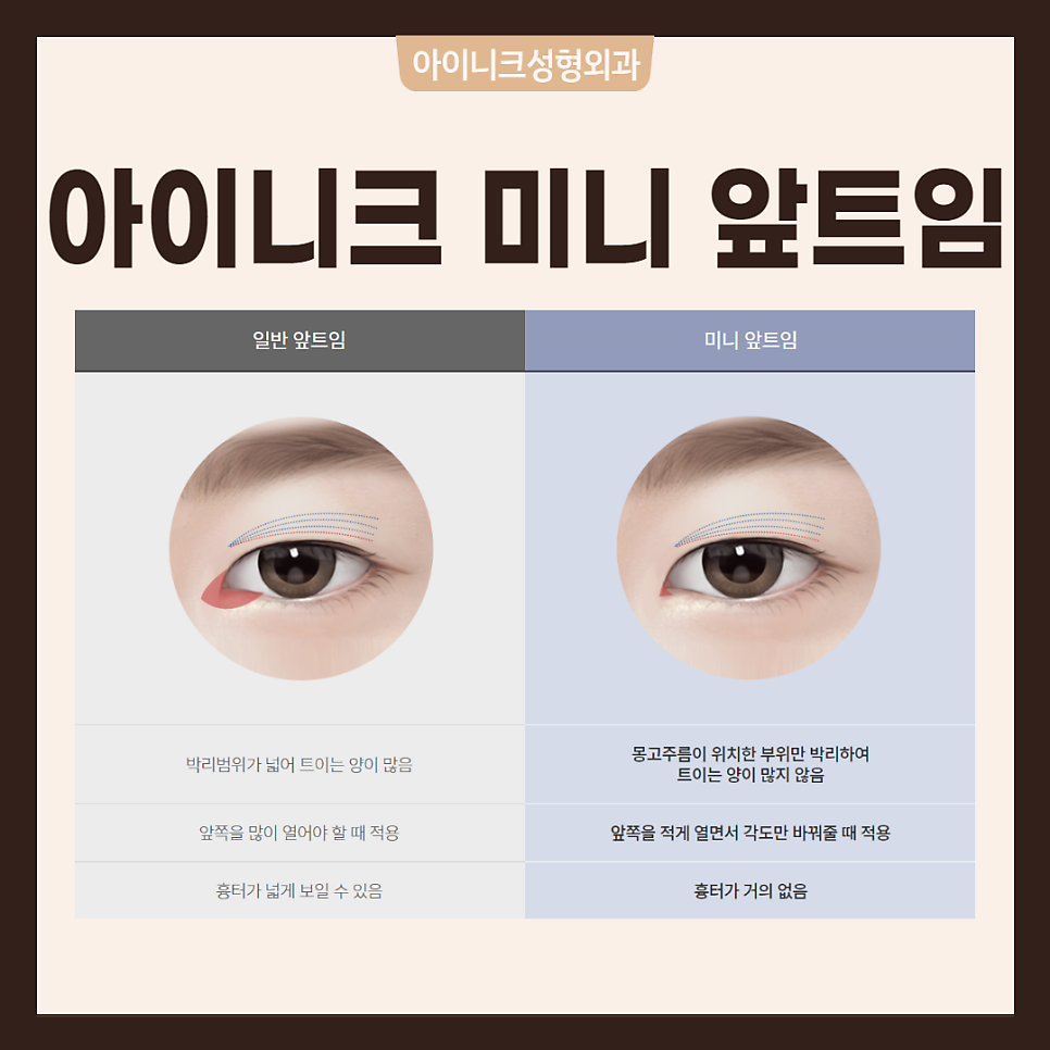 다양한 트임수술 같이 알아봐요! 관련 이미지 3