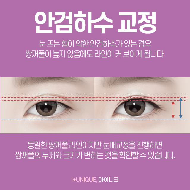 눈재수술 잘하는 곳 신중하게 선택해야하죠! 관련 이미지 4