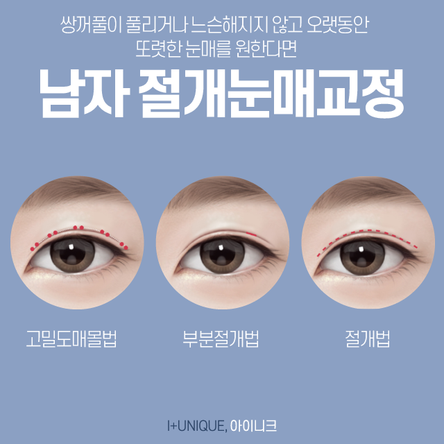 절개? 비절개? 남자눈성형잘하는곳을 찾고 있다면 아이니크에서 그 방법을 알아보자 관련 이미지 3