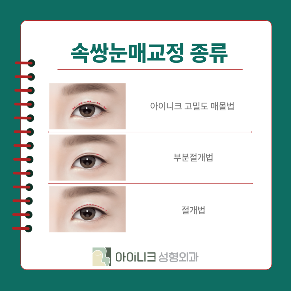 The Best Place for Male Eye Surgery: Natural Results Without Looking Obvious image 8