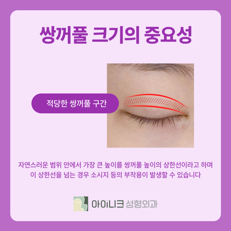 압구정 쌍꺼풀 수술 라인의 종류와 나에게 맞는 방법은? 관련 이미지 6