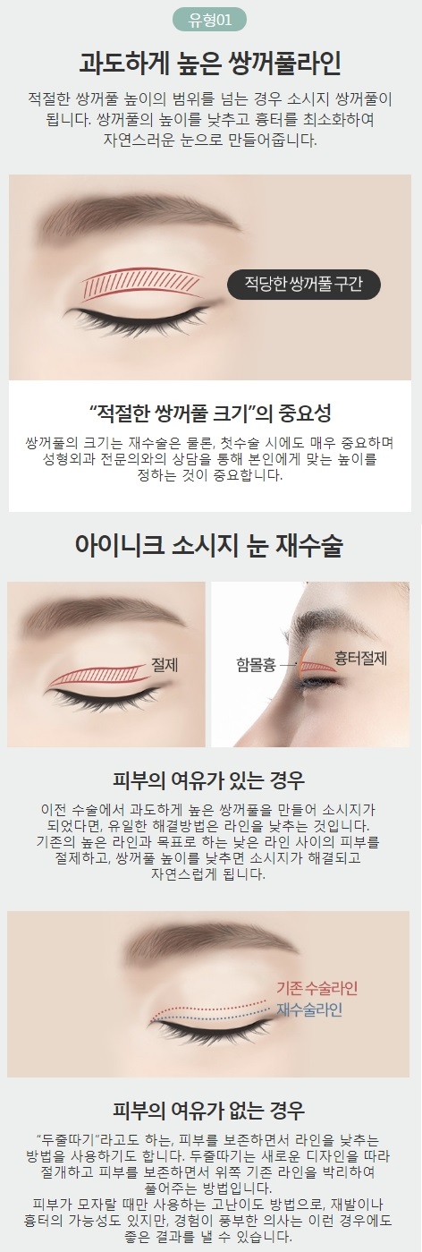 쌍커풀라인낮추기 아이니크 소시지 눈 재수술로 해결! 관련 이미지 3