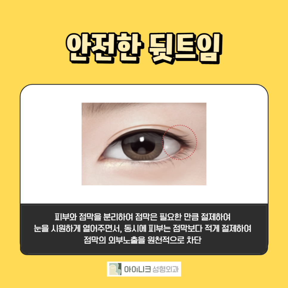 뒷트임밑트임 하기 전 조심해야 할 것은? 관련 이미지 3