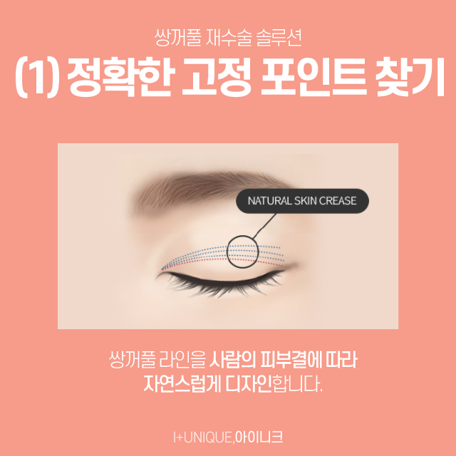 흉터,재수술이 필요하다면 강남쌍꺼풀재수술 잘하는곳 아이니크에서! 관련 이미지 3