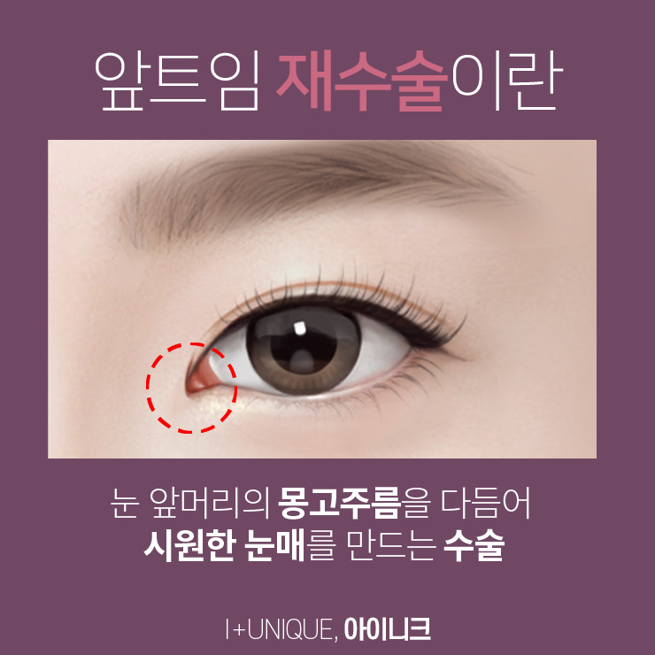 앞트임재건수술 더이상 망설이지 말고 아이니크성형외과로 가자 관련 이미지 2