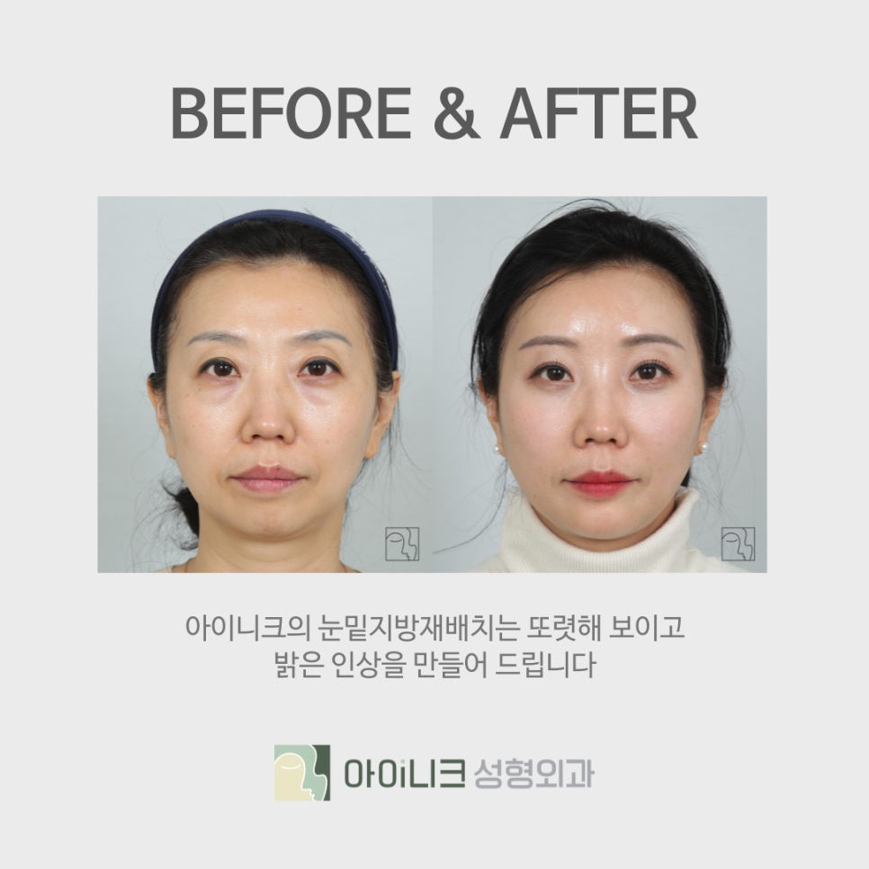 Improving with Under-Eye Fat Repositioning at Sinsa Station image 4