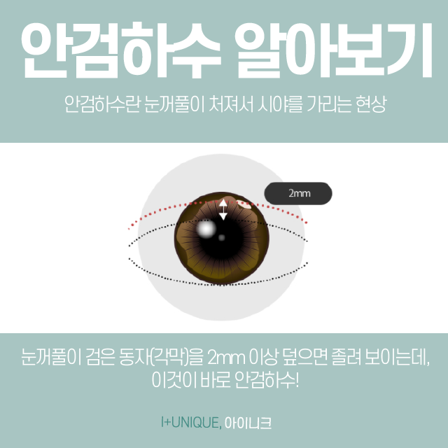 졸려보이는 눈을 또렷하게 안검하수병원추천 관련 이미지 2