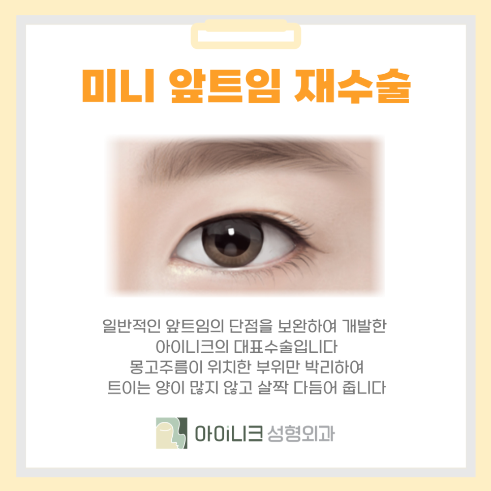 압구정 앞트임 재수술 꼼꼼함이 중요해요 관련 이미지 6