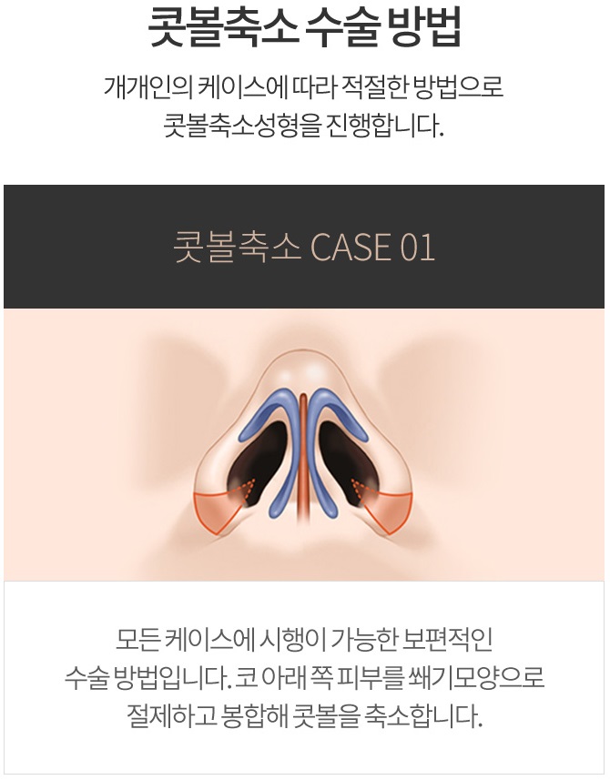 콧볼축소수술가격이 궁금하다면 click! 관련 이미지 4