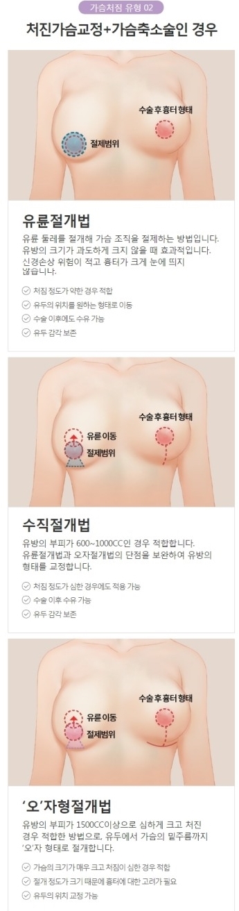 가슴처짐수술비용 궁금하다면 자연스러운 아이니크로! 관련 이미지 4