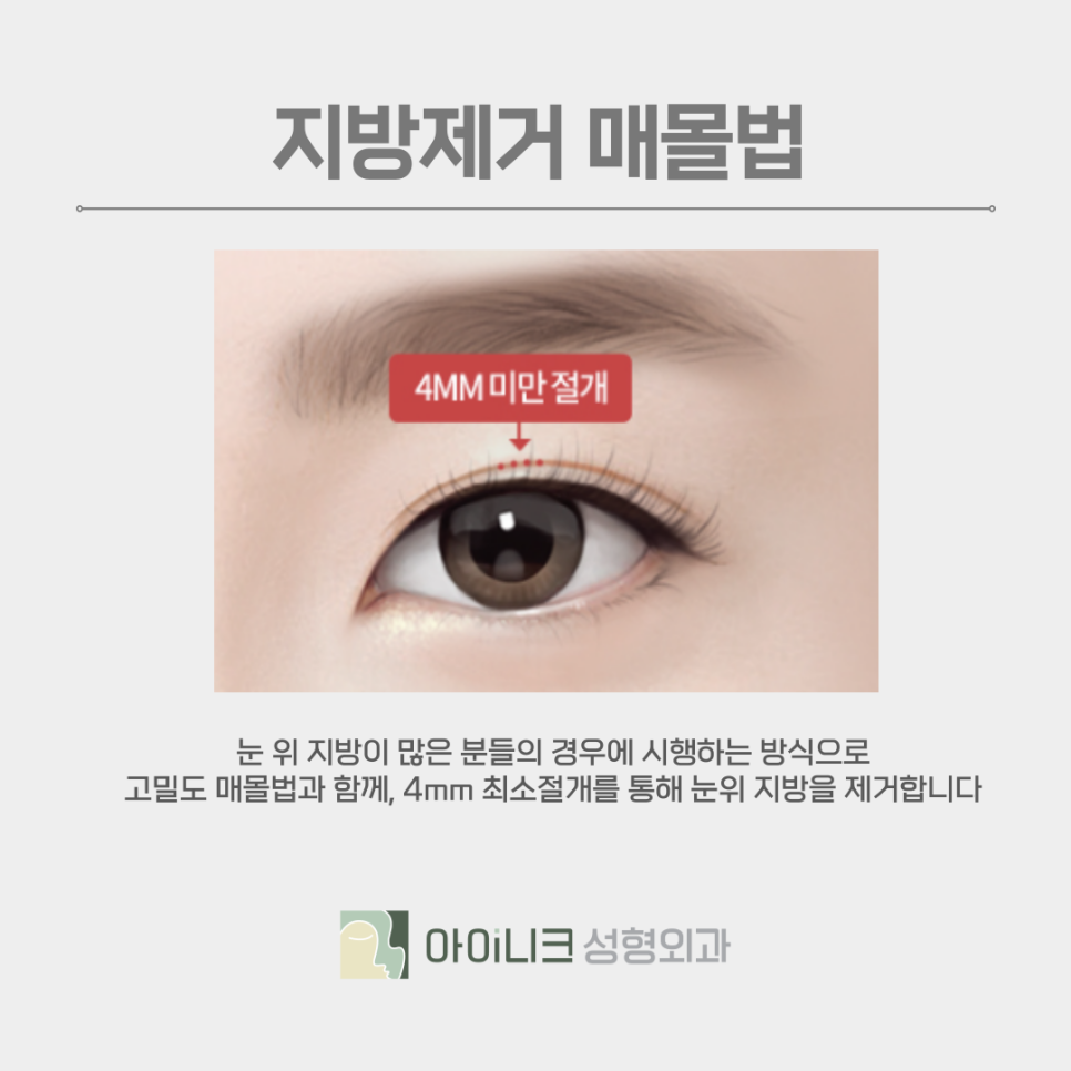 쌍꺼풀종류 본인의 눈 상태에 맞게 선택하기 관련 이미지 12
