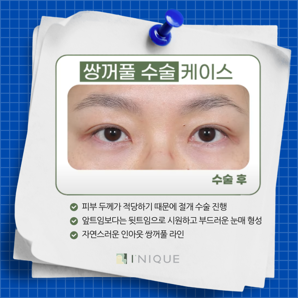 Apgujeong Eye Plastic Surgery Clinic: Let’s Decide by Looking at Real Surgery Cases! image 6