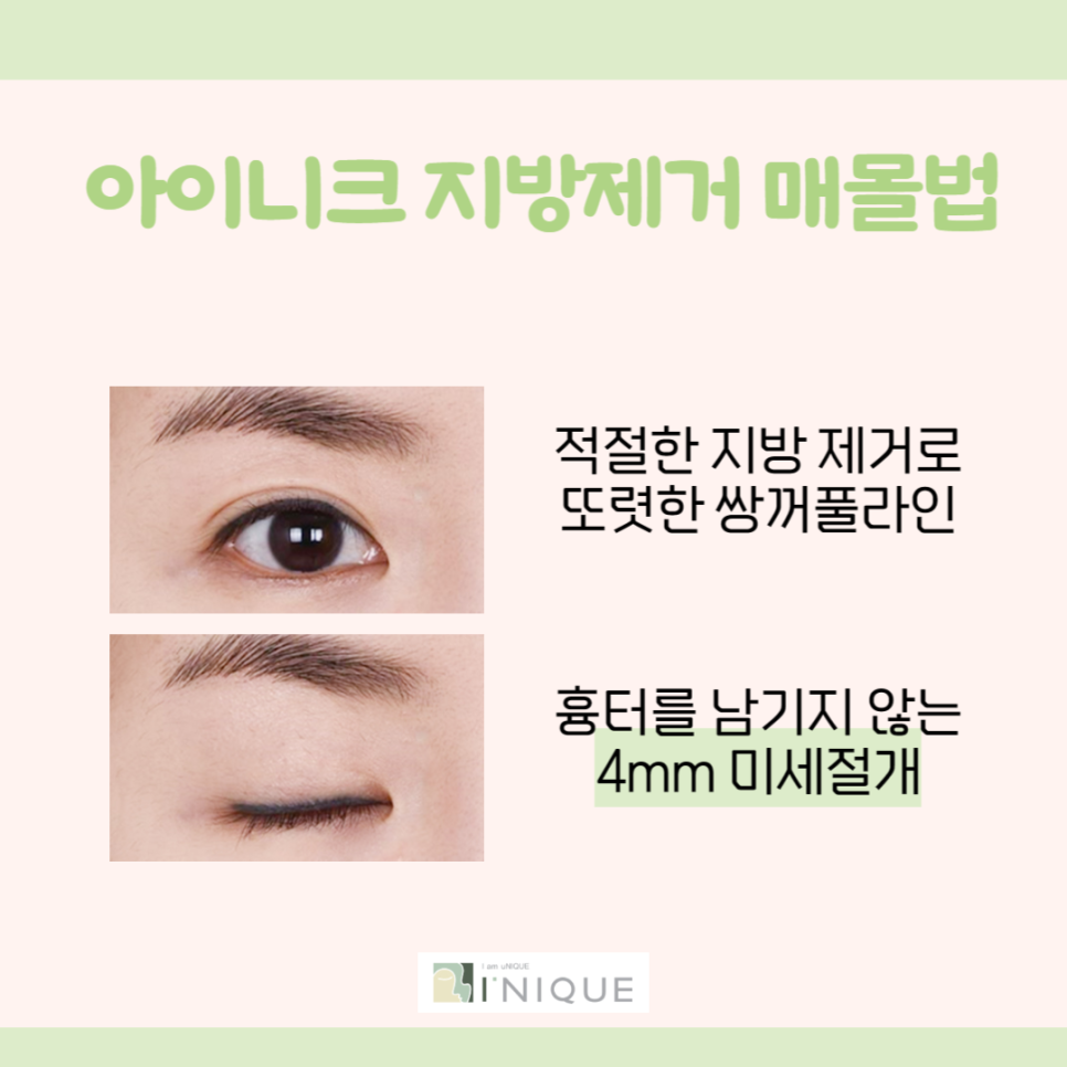 쌍꺼풀만들기 고민하고 계신가요? 관련 이미지 5