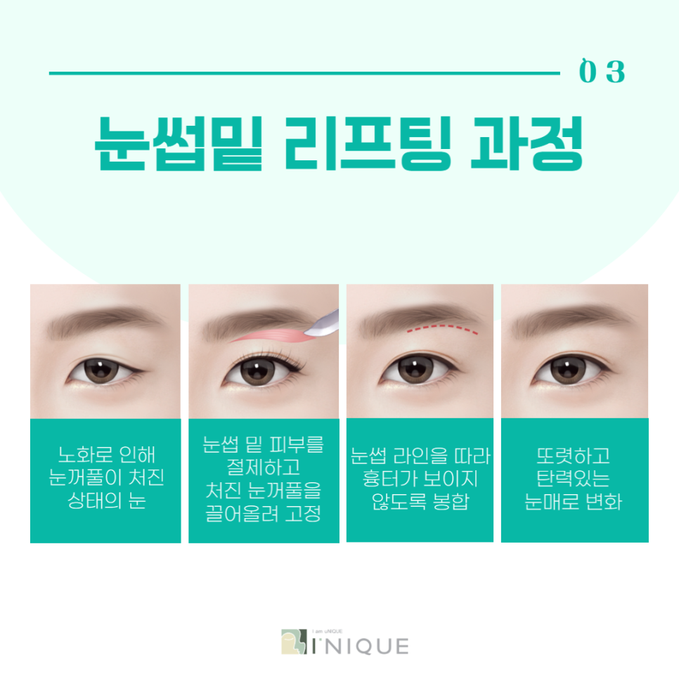 중년눈수술로 다시 20대의 눈매로 관련 이미지 4