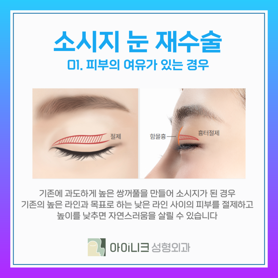 눈재수술비용 보다 중요한 소시지 쌍꺼풀 개선방식 관련 이미지 9