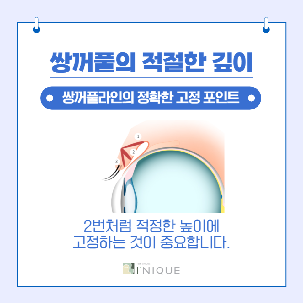 Women’s Double Eyelid Surgery, Naturally with Refined Technique image 3