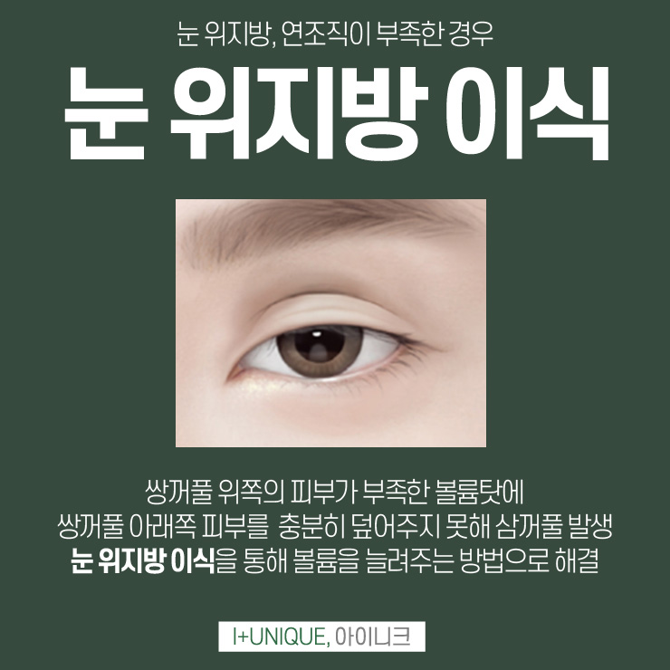 압구정눈재수술병원 방황하지 말고 아이니크성형외과에서 관련 이미지 4