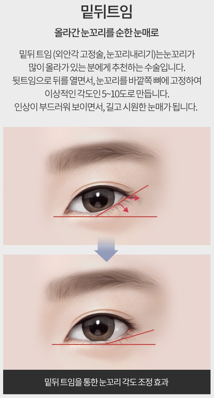 뒤트임복원 아이니크를 찾는 이유 관련 이미지 5