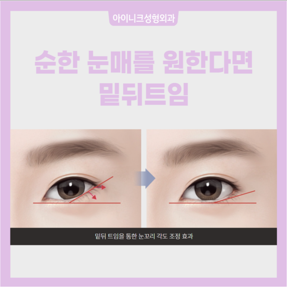 눈트임성형 자연스럽고 아름답게! 관련 이미지 5