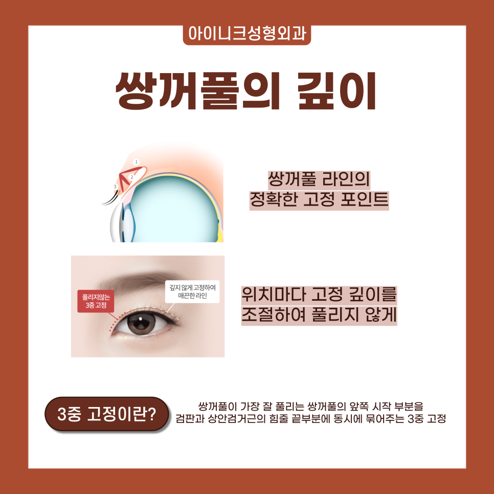 서울 쌍수 라인으로 자연스럽게! 관련 이미지 5
