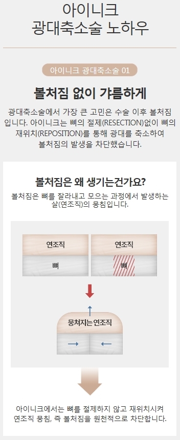 광대축소술가격 합리적인 곳 관련 이미지 2