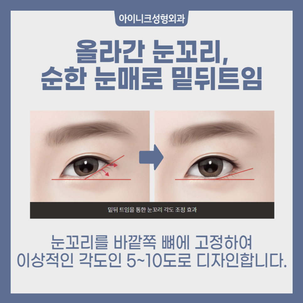 The Secret to a Natural, Clear Eye Shape with Outer Corner Surgery image 5